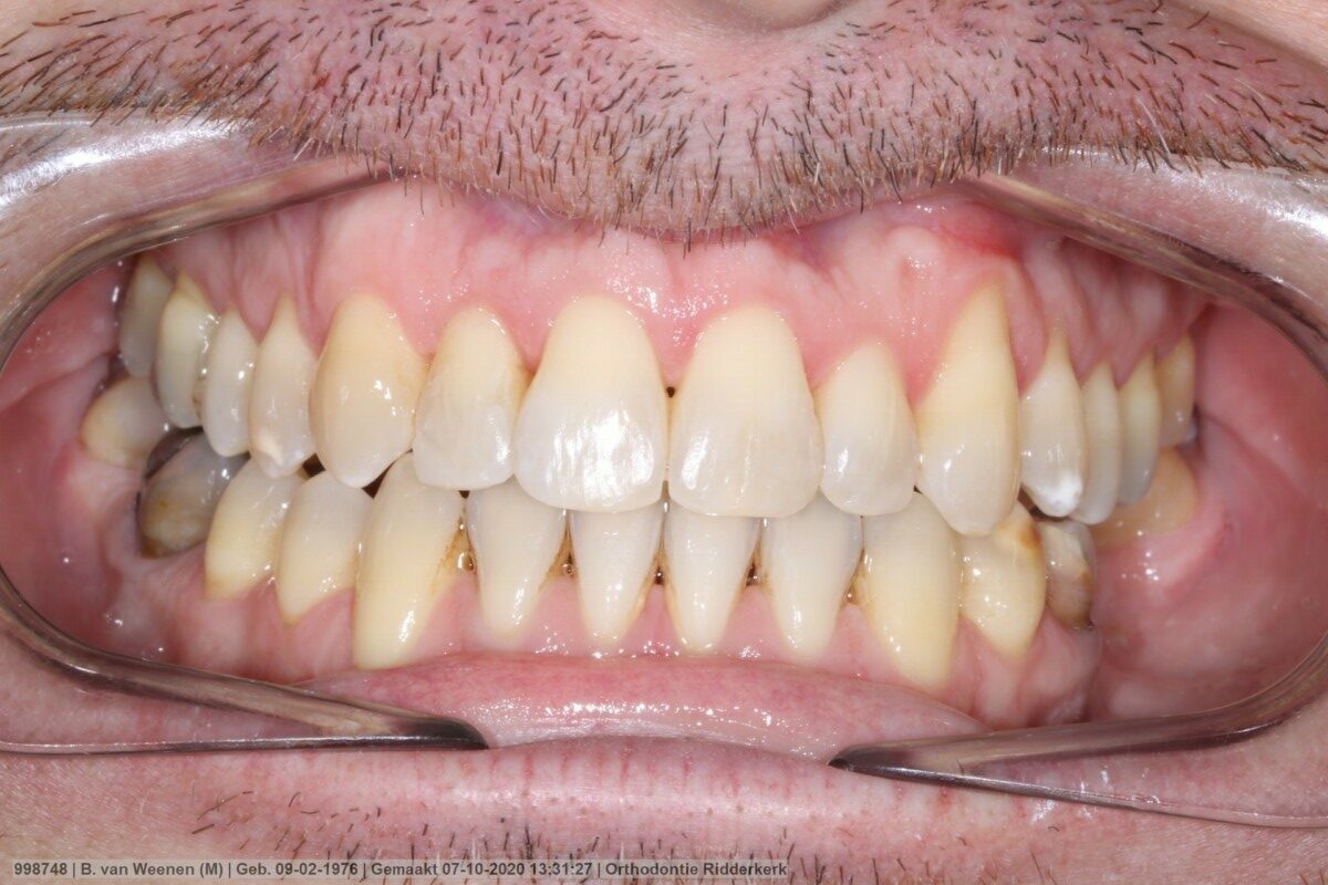 After image
