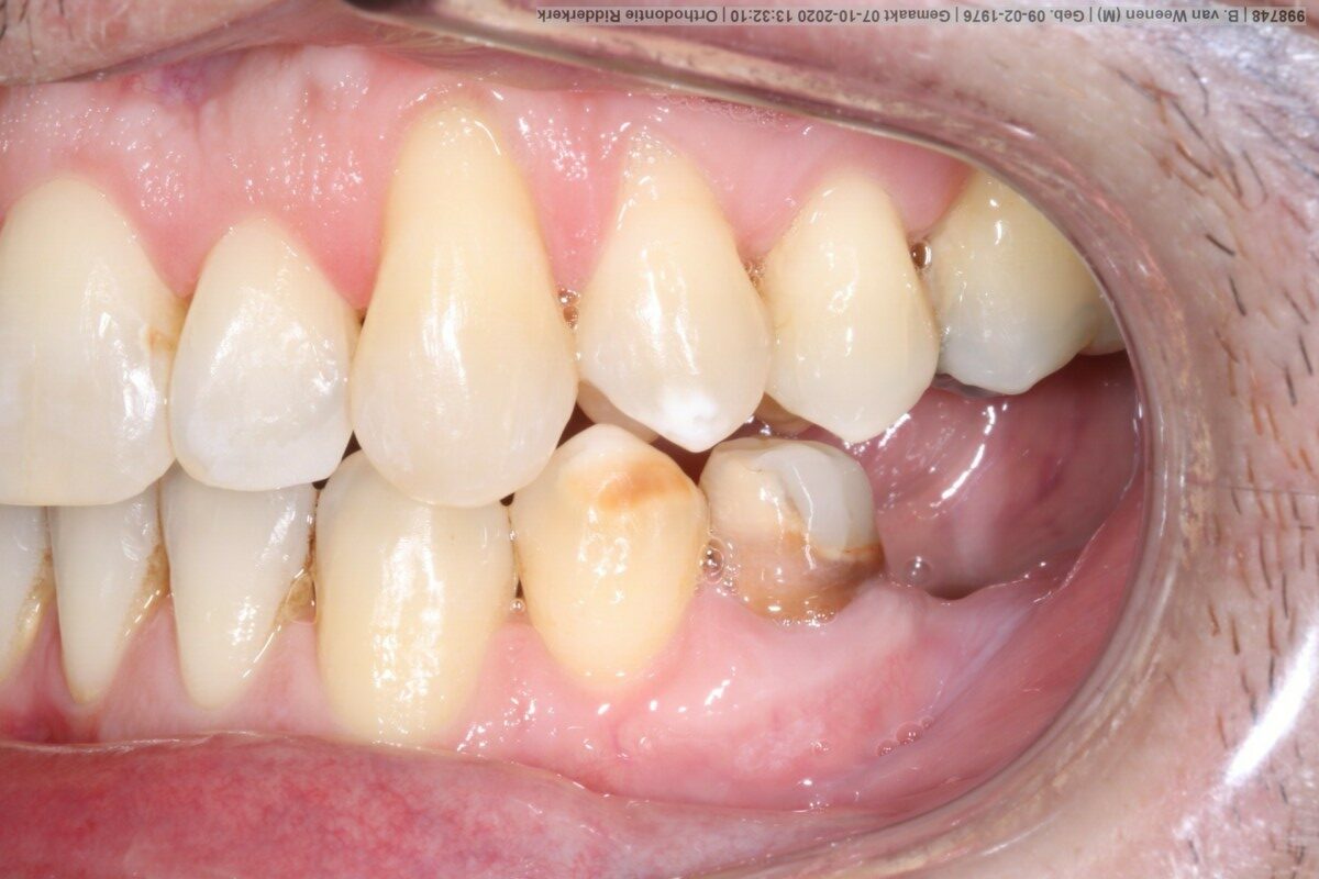 After image
