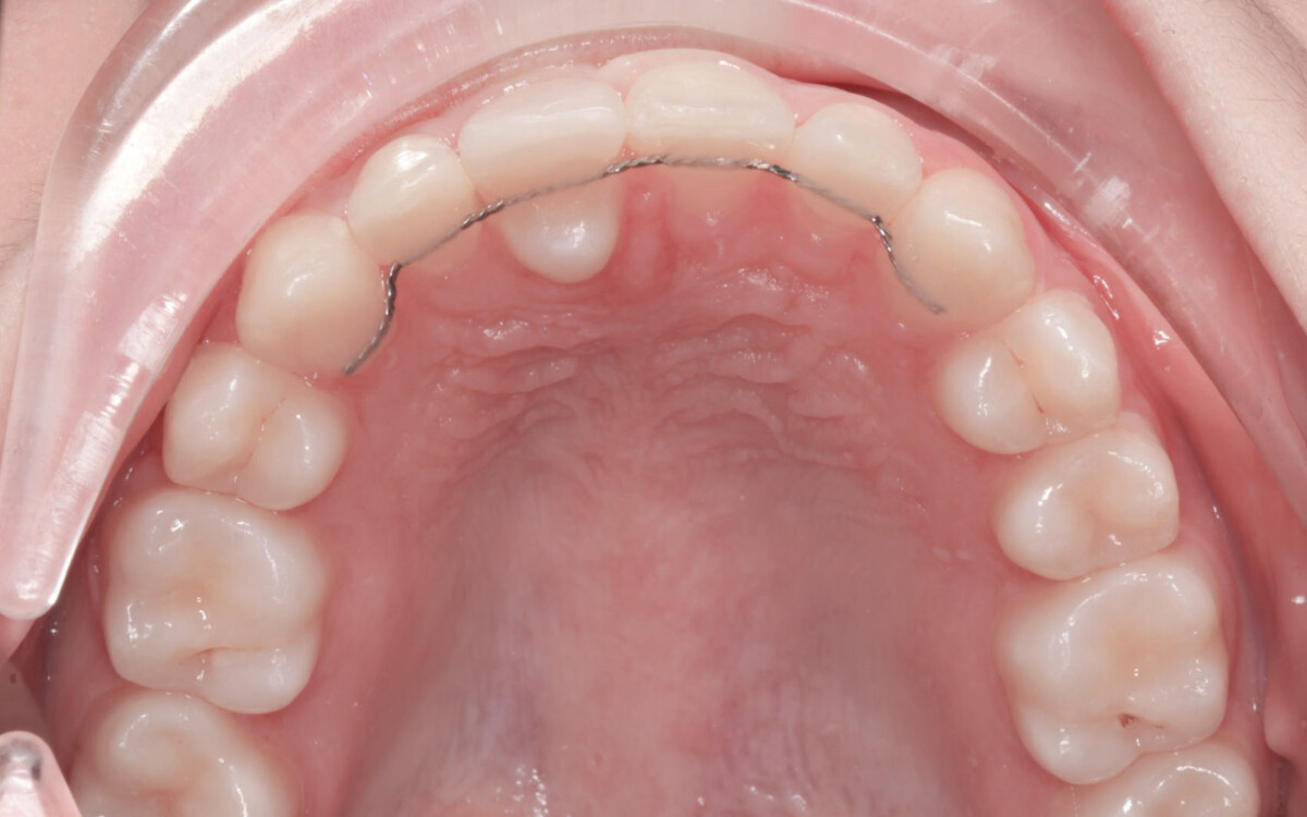 After image