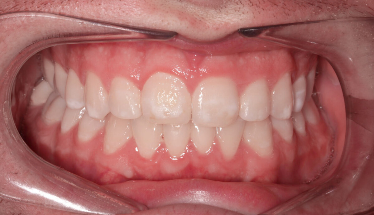 After image
