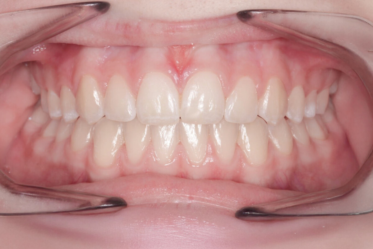 After image
