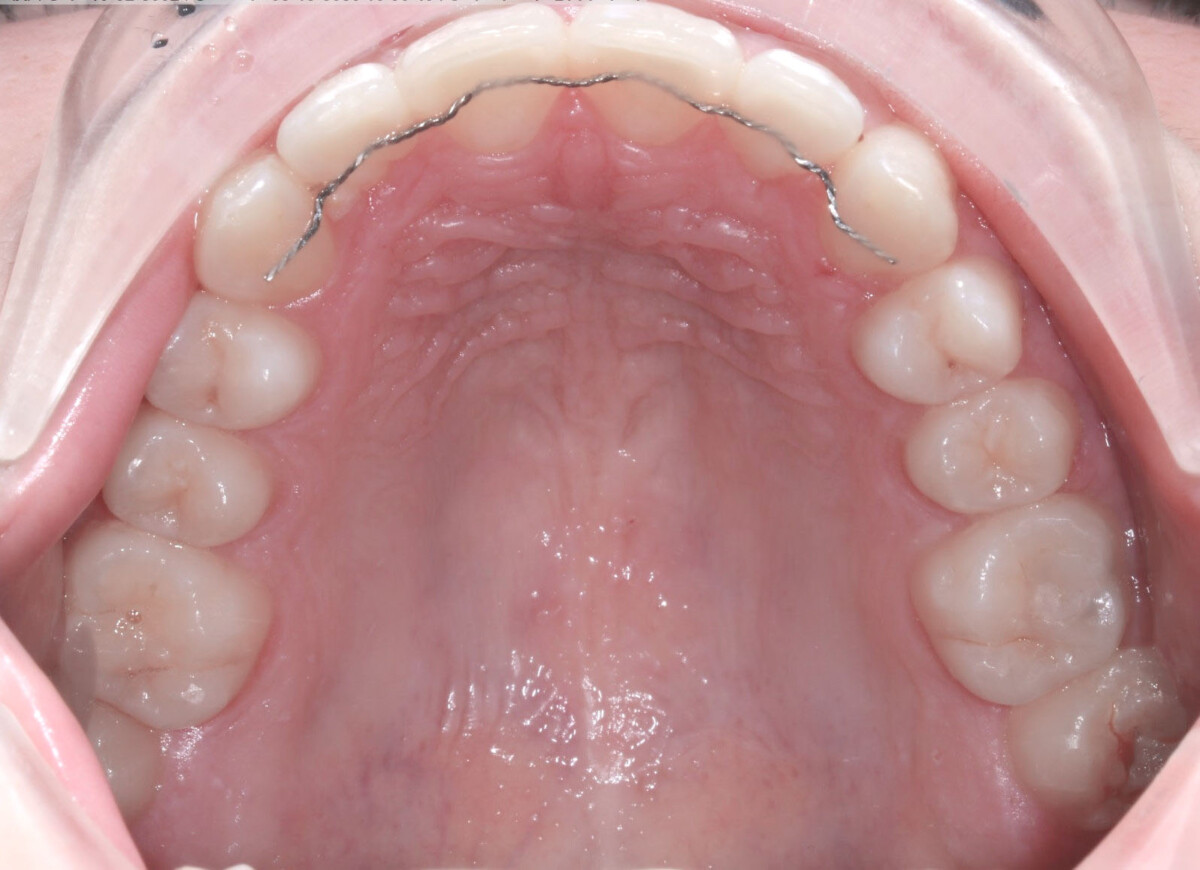 After image