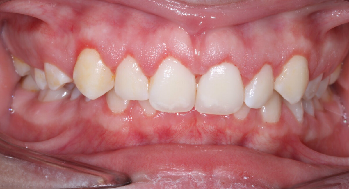After image