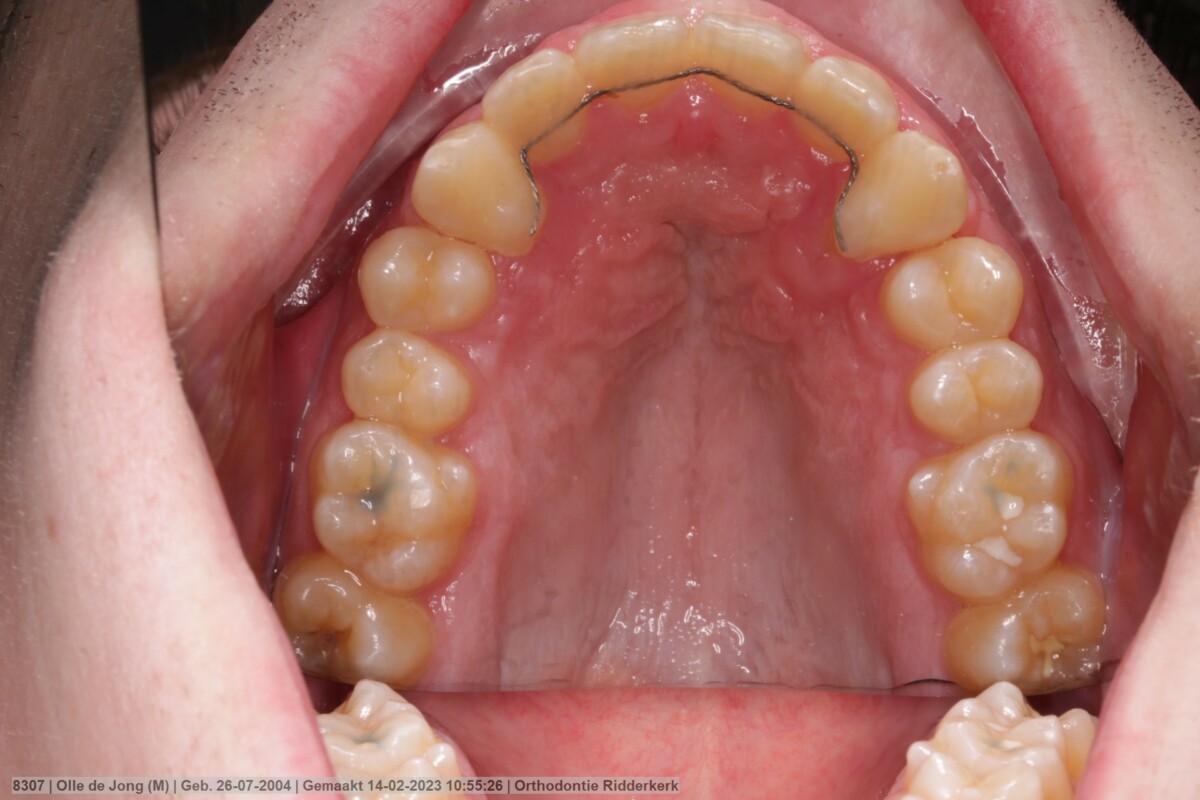 After image