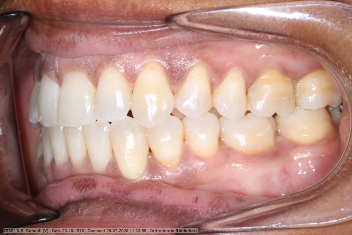 After image