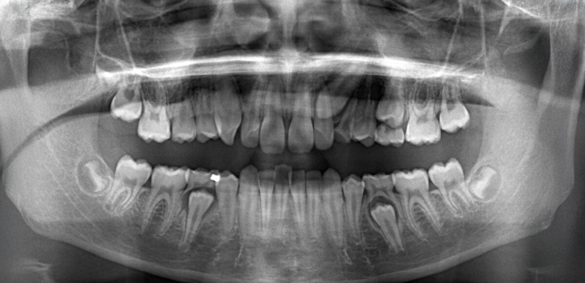 After image